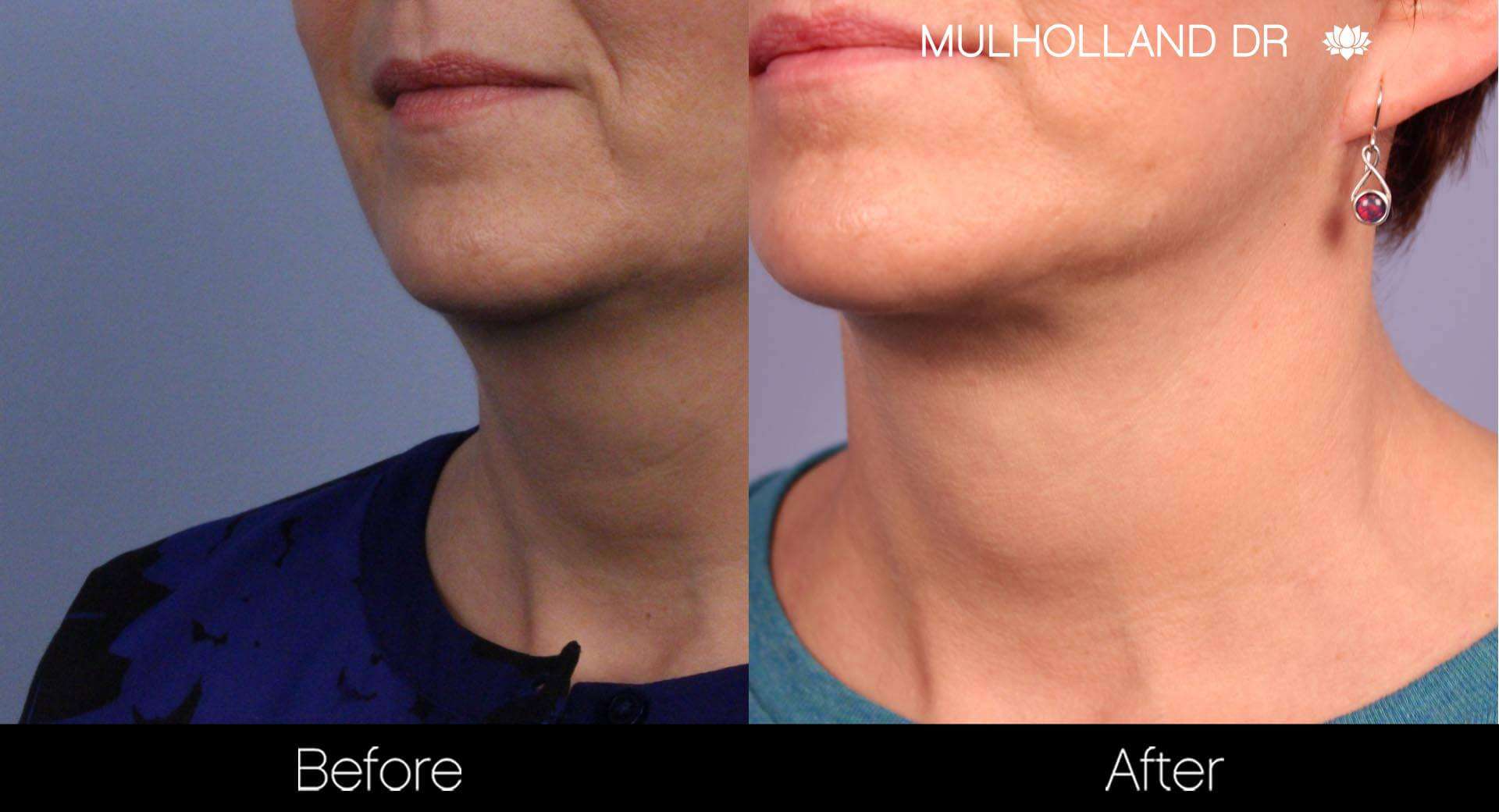 Neck Lift - Before and After Gallery - Patient Photo 89