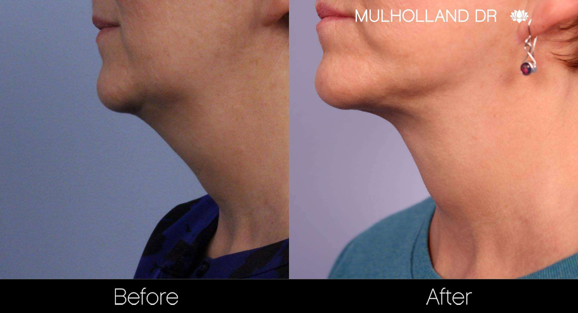 Neck Lift - Before and After Gallery - Patient Photo 90