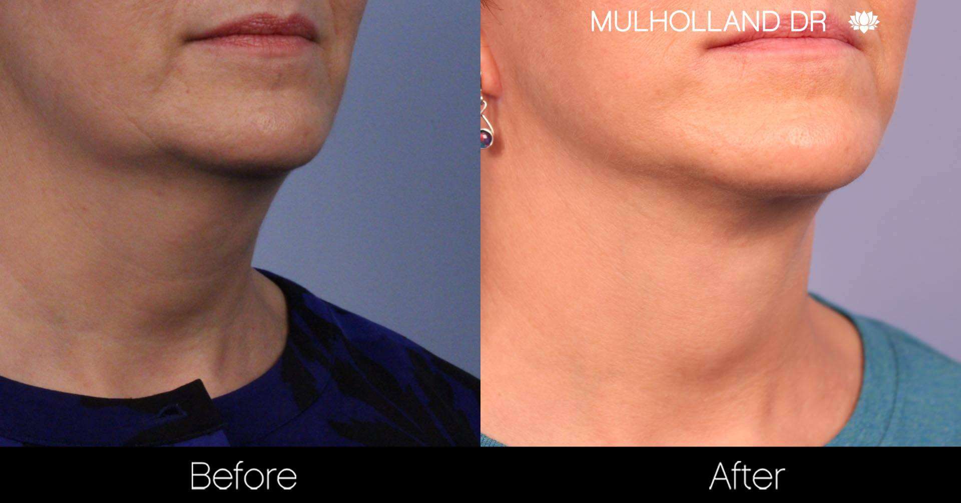 Neck Lift - Before and After Gallery - Patient Photo 91