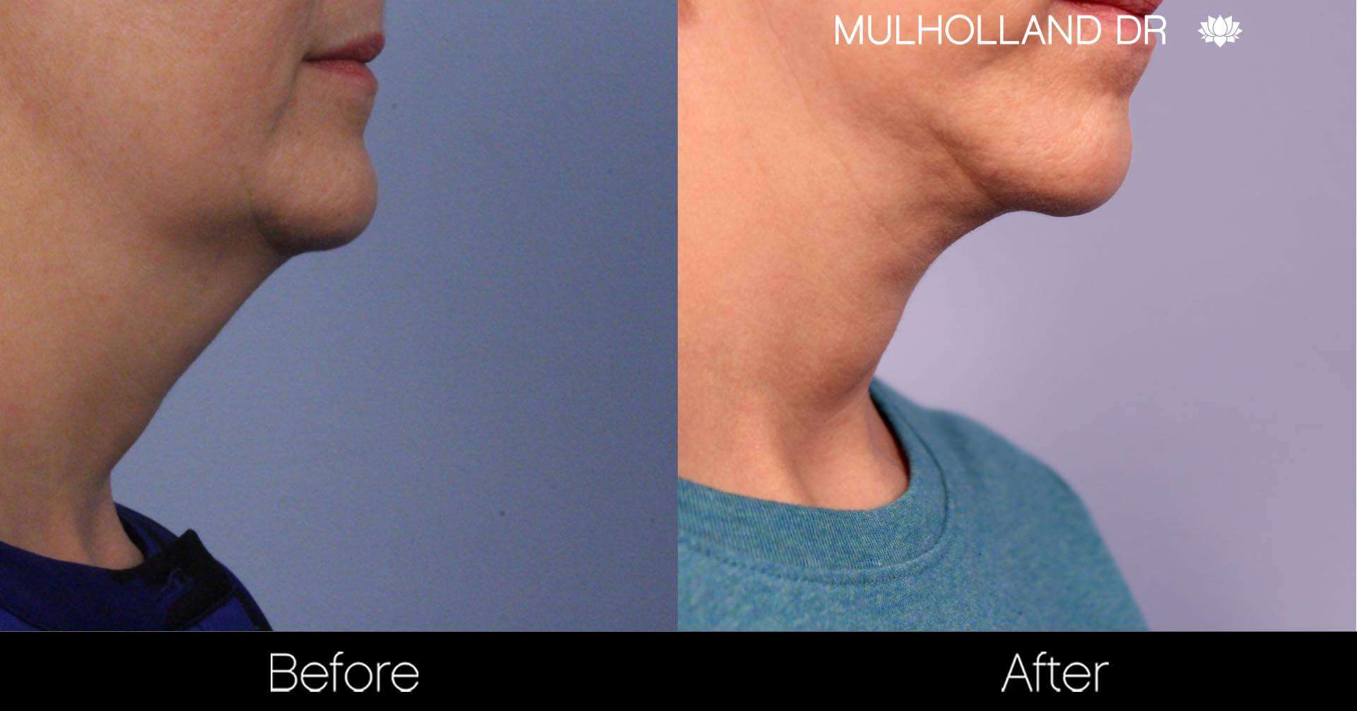 Neck Lift - Before and After Gallery - Patient Photo 92