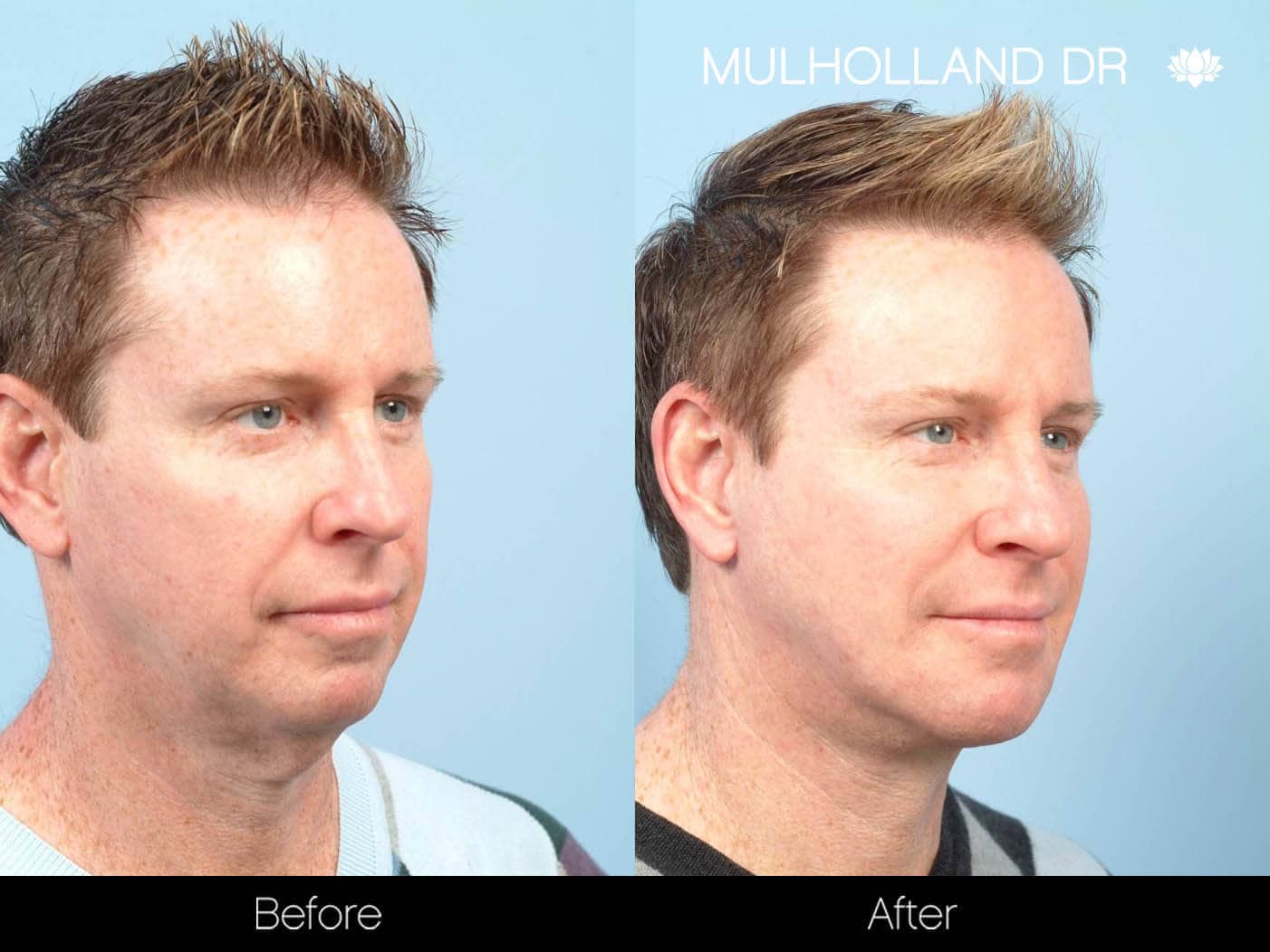Neck Lift - Before and After Gallery - Patient Photo 94
