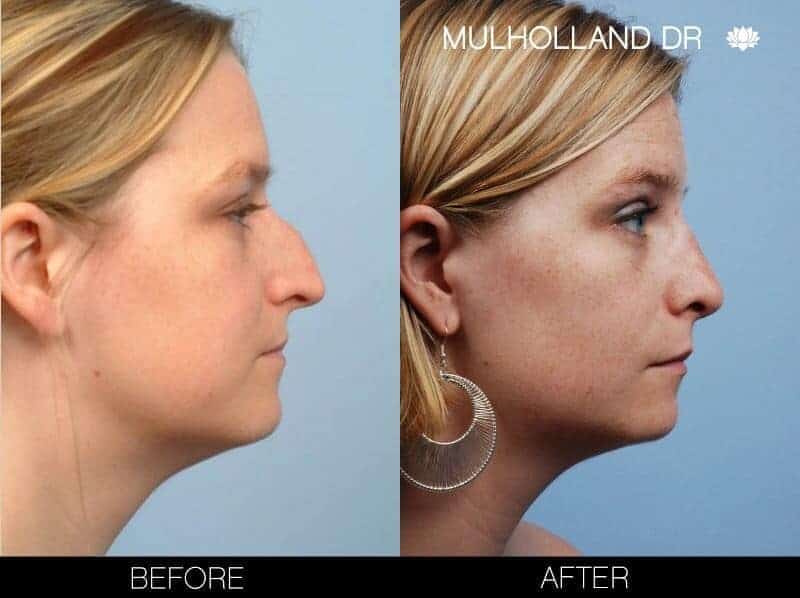 Rhinoplasty - Before and After Gallery - Patient Photo 10