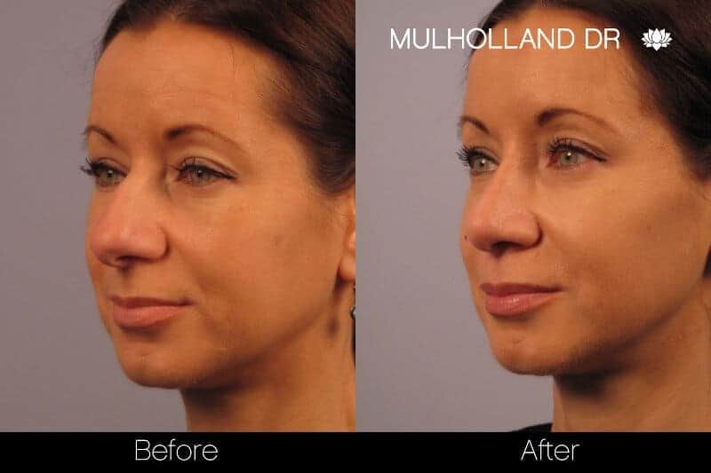 Rhinoplasty - Before and After Gallery - Patient Photo 14