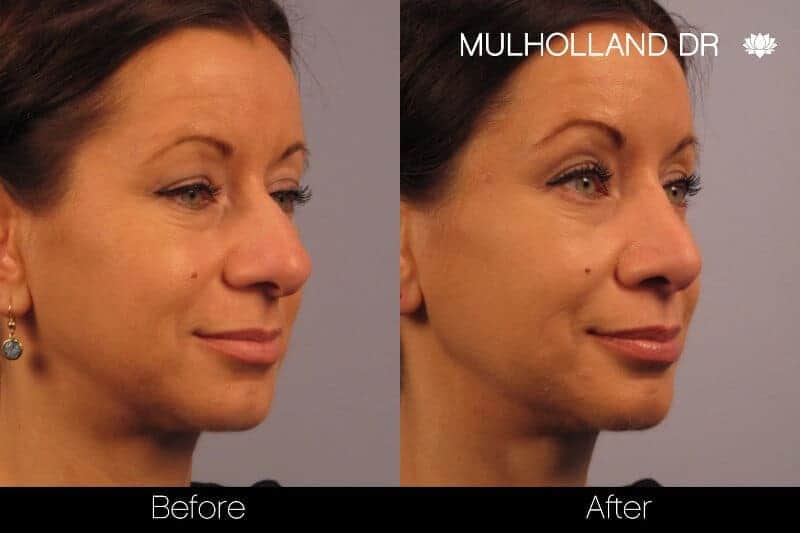 Rhinoplasty - Before and After Gallery - Patient Photo 15