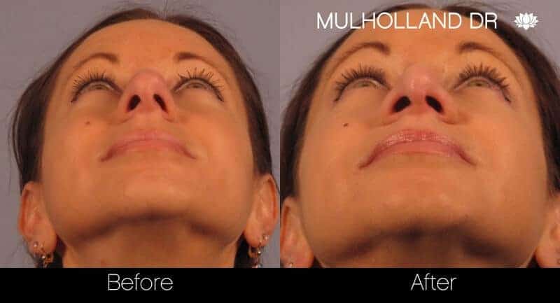 Rhinoplasty - Before and After Gallery - Patient Photo 16