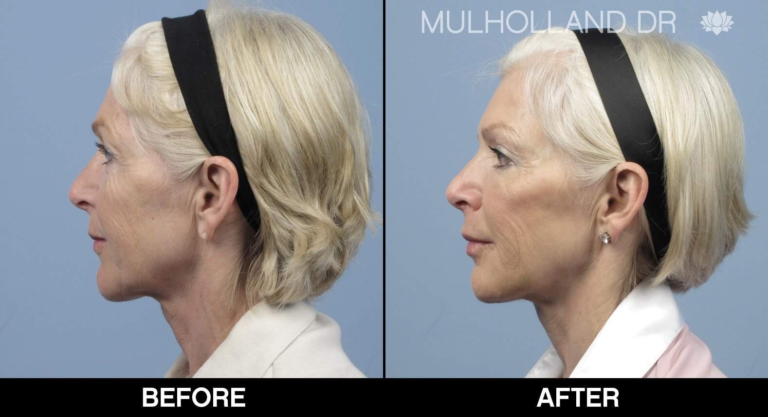 Rhinoplasty - Before and After Gallery - Patient Photo 17