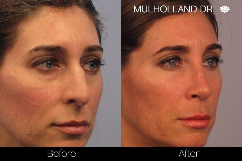 Rhinoplasty - Before and After Gallery - Patient Photo 2