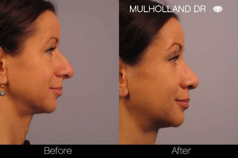 Rhinoplasty - Before and After Gallery - Patient Photo 20