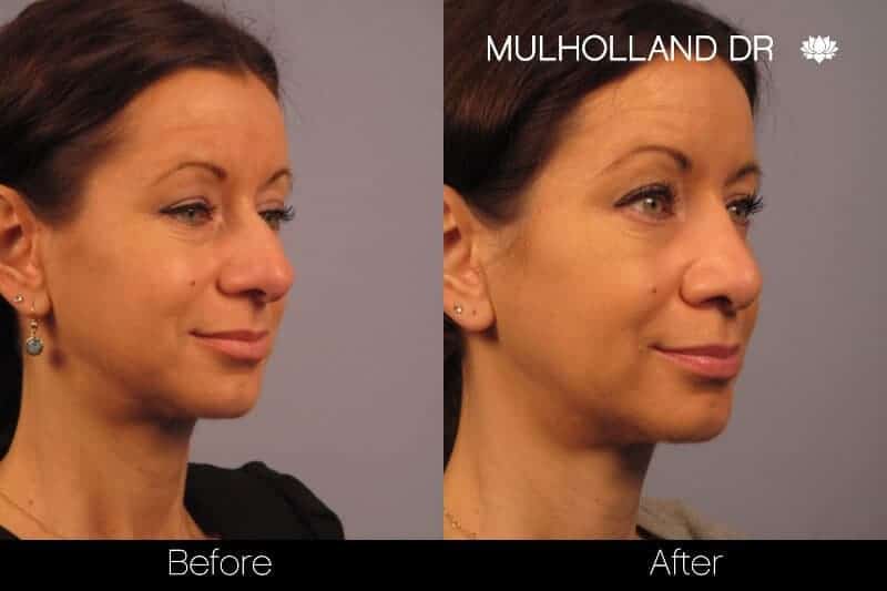Rhinoplasty - Before and After Gallery - Patient Photo 24