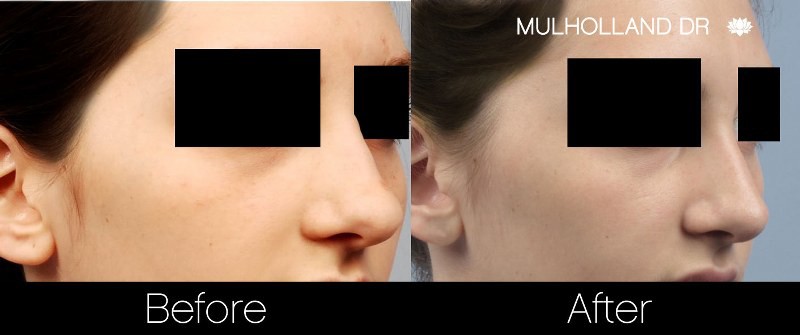 Rhinoplasty - Before and After Gallery - Patient Photo 26