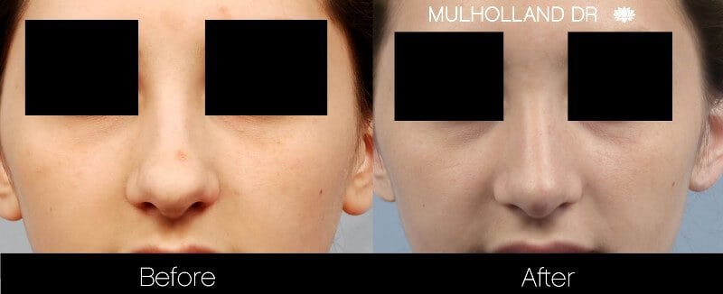 Rhinoplasty - Before and After Gallery - Patient Photo 27