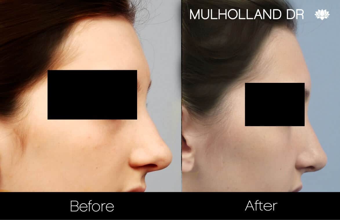 Rhinoplasty - Before and After Gallery - Patient Photo 28