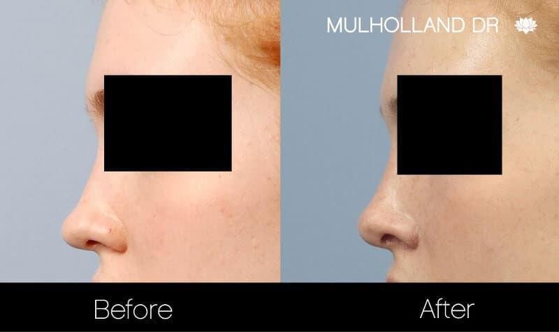 Rhinoplasty - Before and After Gallery - Patient Photo 29
