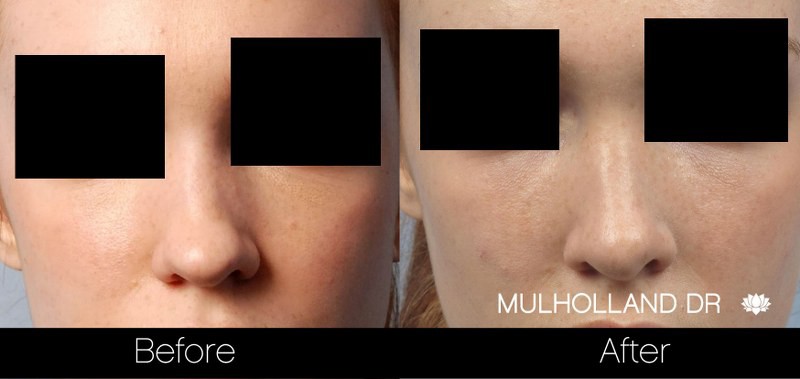 Rhinoplasty - Before and After Gallery - Patient Photo 30