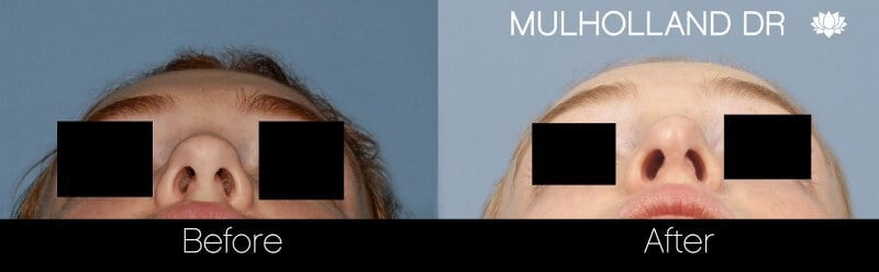 Rhinoplasty - Before and After Gallery - Patient Photo 31