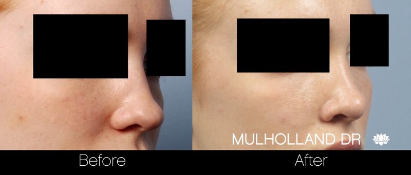Rhinoplasty - Before and After Gallery - Patient Photo 32