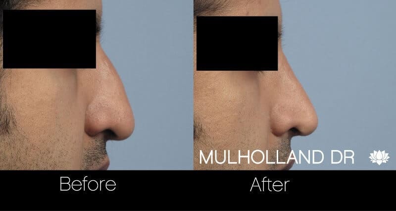 Rhinoplasty - Before and After Gallery - Patient Photo 33