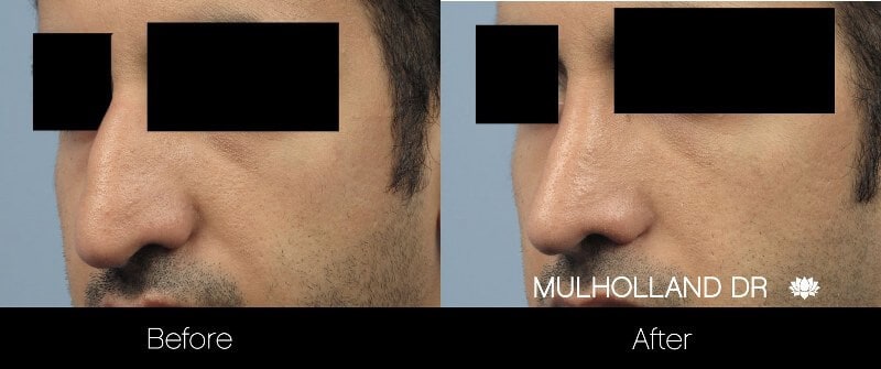Rhinoplasty - Before and After Gallery - Patient Photo 34