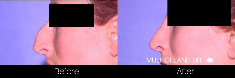 Rhinoplasty - Before and After Gallery - Patient Photo 35