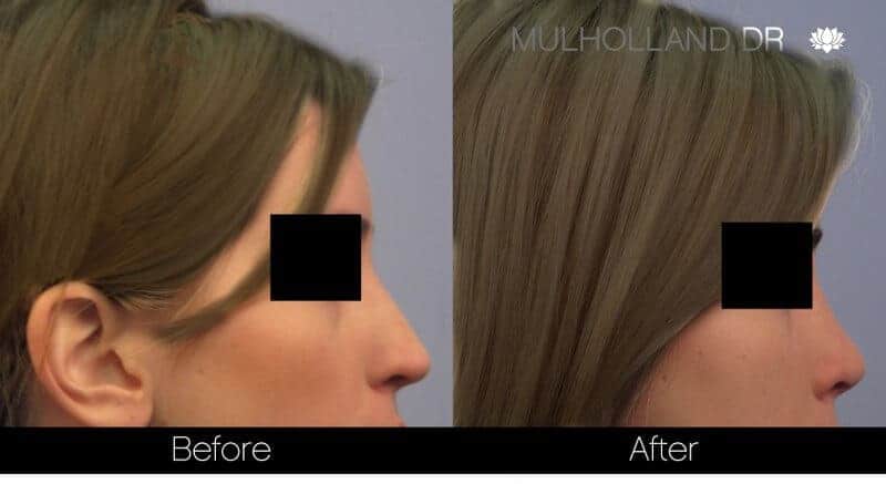 Rhinoplasty - Before and After Gallery - Patient Photo 37