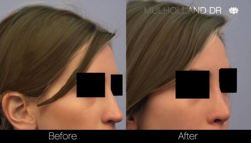 Rhinoplasty - Before and After Gallery - Patient Photo 38