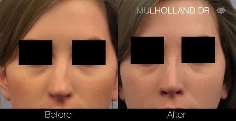 Rhinoplasty - Before and After Gallery - Patient Photo 39