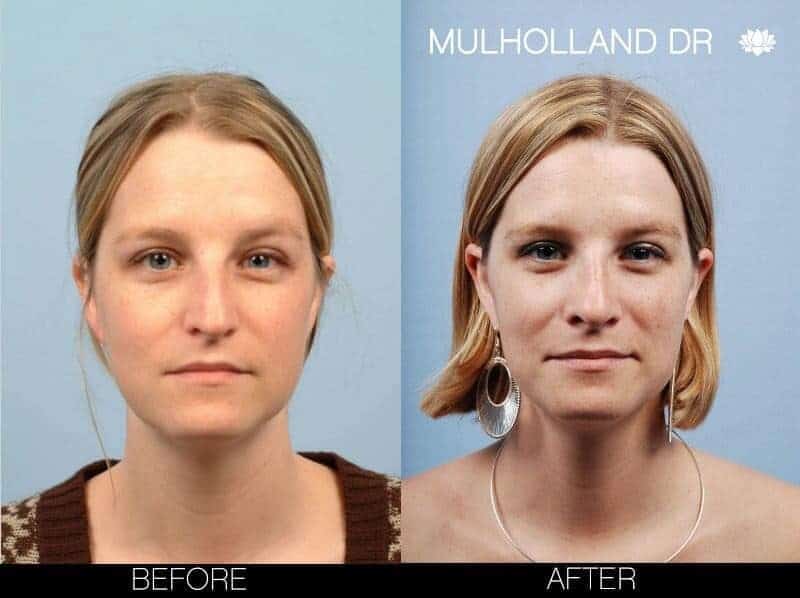 Rhinoplasty - Before and After Gallery - Patient Photo 5