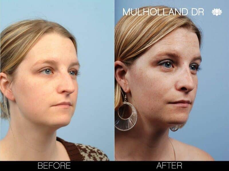 Rhinoplasty - Before and After Gallery - Patient Photo 7