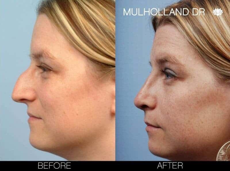 Rhinoplasty - Before and After Gallery - Patient Photo 9