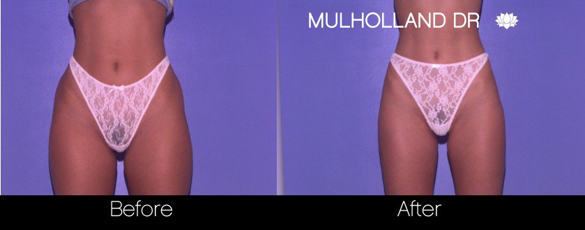 SmartLipo - Before and After Gallery - Patient Photo 61