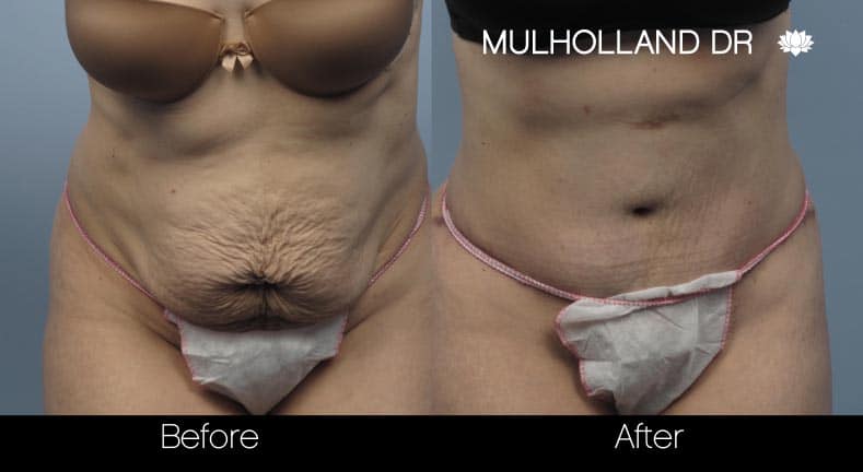 Tummy Tuck -Before and After Gallery - Patient Photo 10