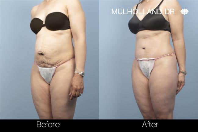 Tummy Tuck -Before and After Gallery - Patient Photo 12