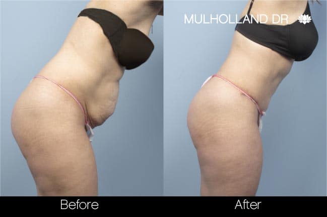 Tummy Tuck -Before and After Gallery - Patient Photo 13
