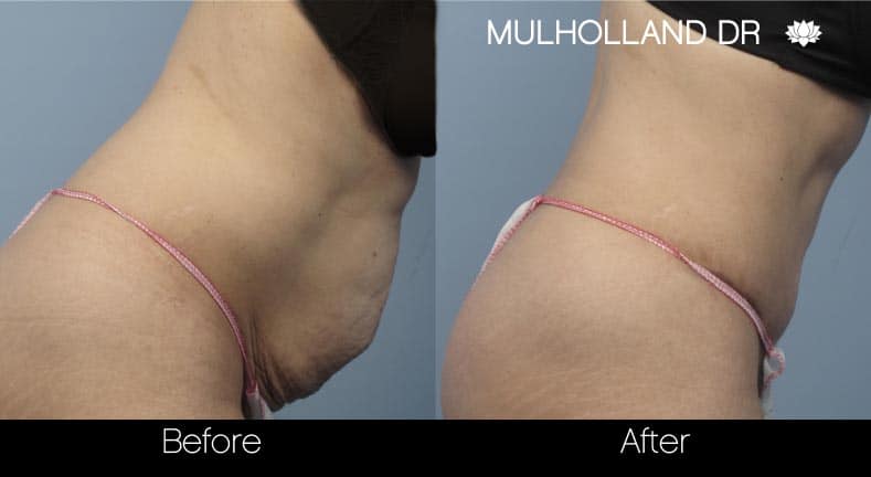 Tummy Tuck -Before and After Gallery - Patient Photo 14