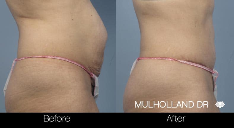 Tummy Tuck -Before and After Gallery - Patient Photo 15