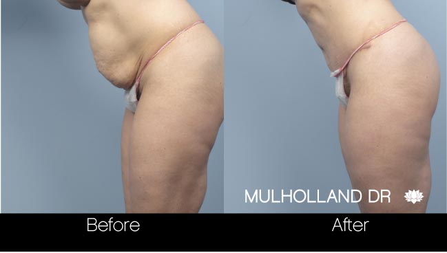 Tummy Tuck -Before and After Gallery - Patient Photo 16