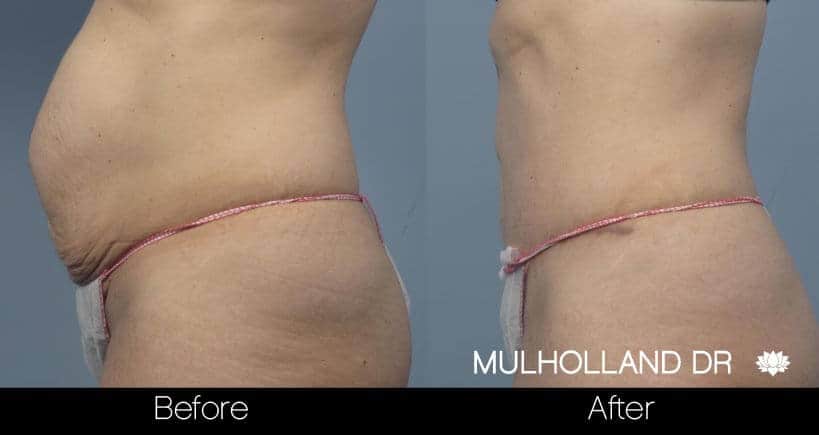 Tummy Tuck -Before and After Gallery - Patient Photo 18