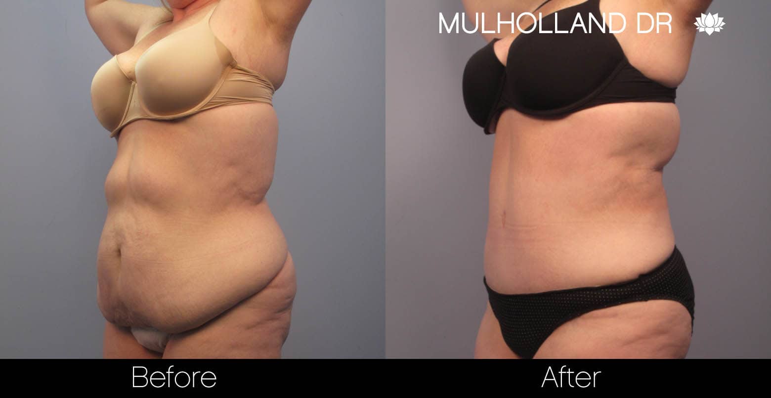 Tummy Tuck -Before and After Gallery - Patient Photo 2
