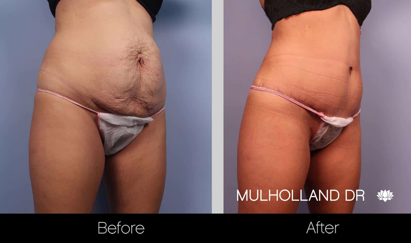 Tummy Tuck -Before and After Gallery - Patient Photo 20