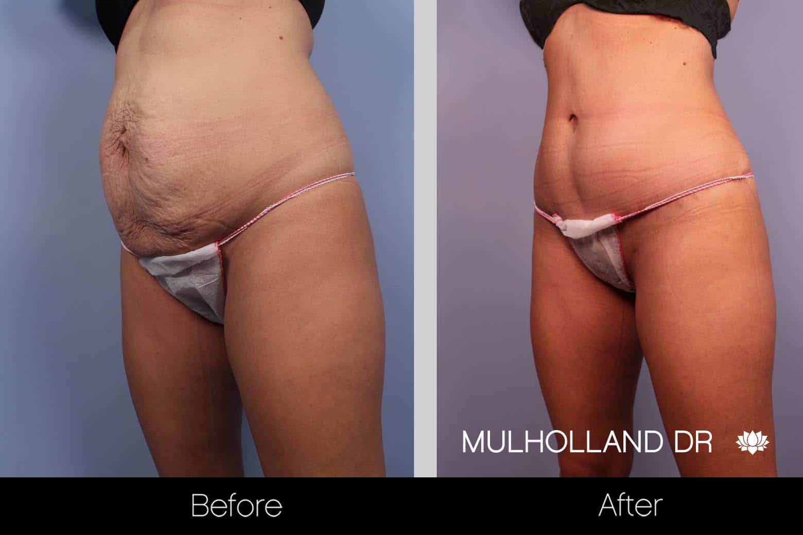 Tummy Tuck -Before and After Gallery - Patient Photo 21