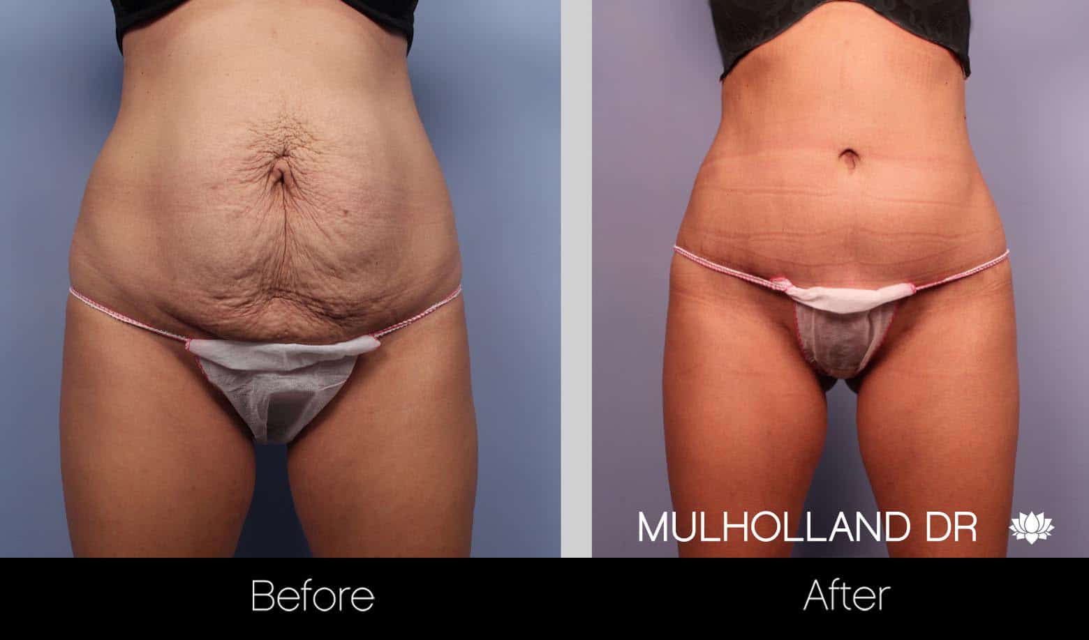 Tummy Tuck -Before and After Gallery - Patient Photo 22