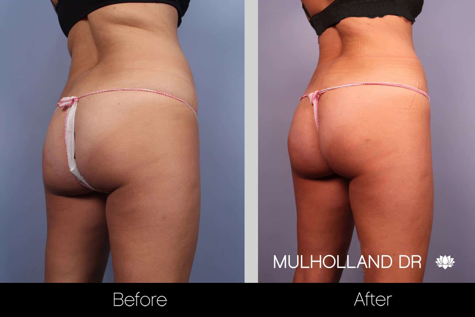 Tummy Tuck -Before and After Gallery - Patient Photo 23