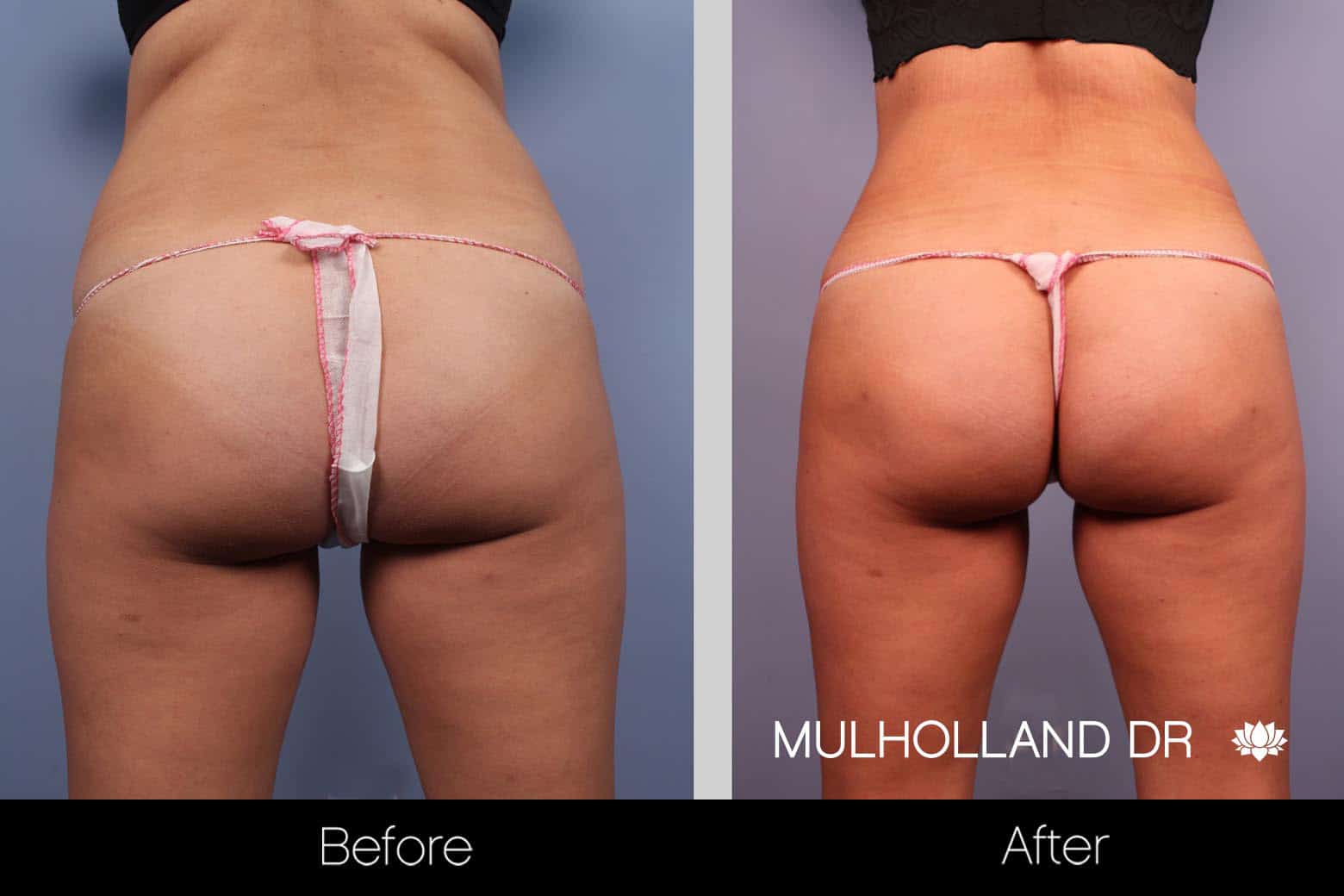 Tummy Tuck -Before and After Gallery - Patient Photo 25