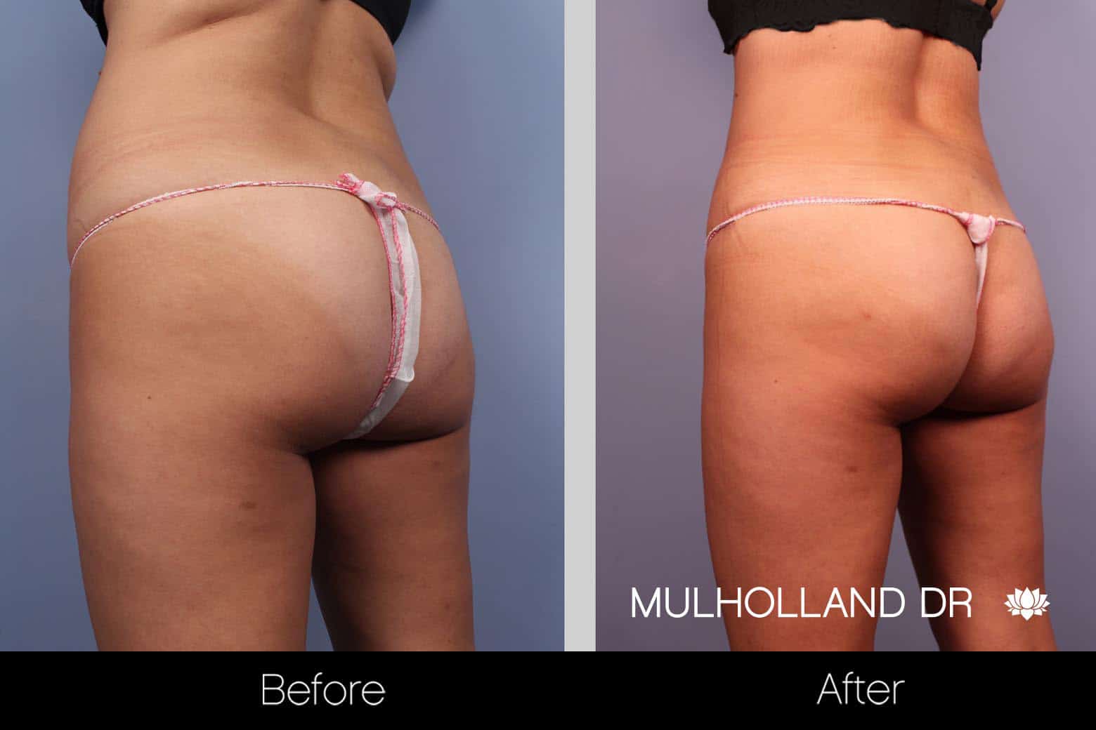 Tummy Tuck -Before and After Gallery - Patient Photo 26
