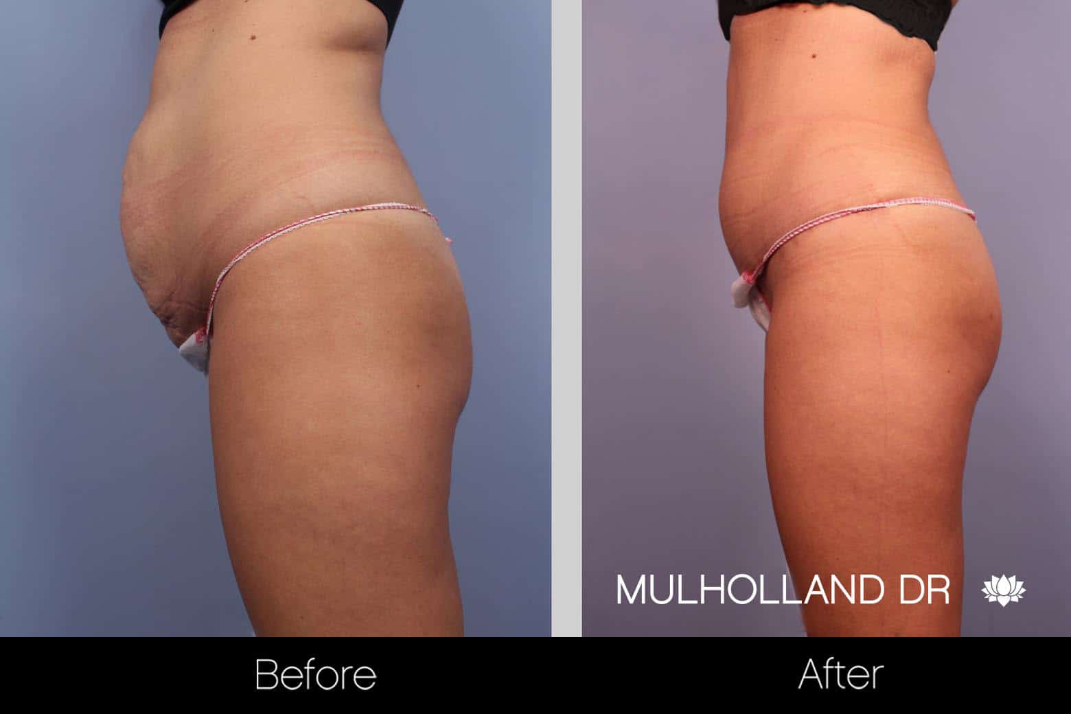 Tummy Tuck -Before and After Gallery - Patient Photo 27