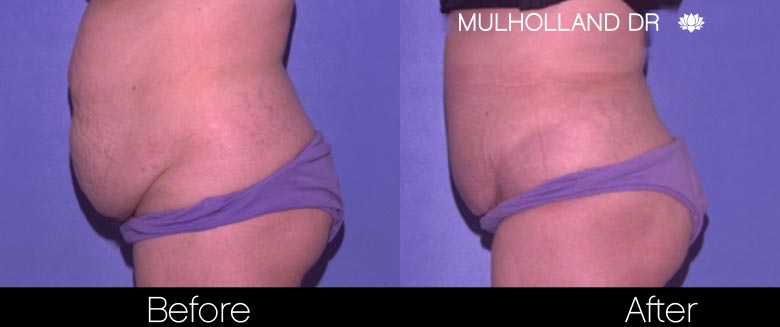 Tummy Tuck -Before and After Gallery - Patient Photo 28