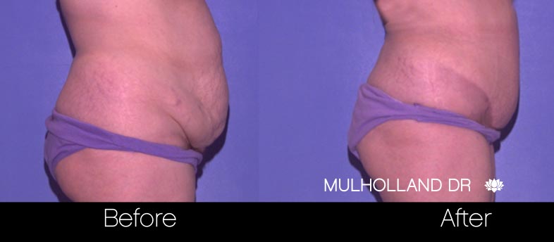 Tummy Tuck -Before and After Gallery - Patient Photo 29