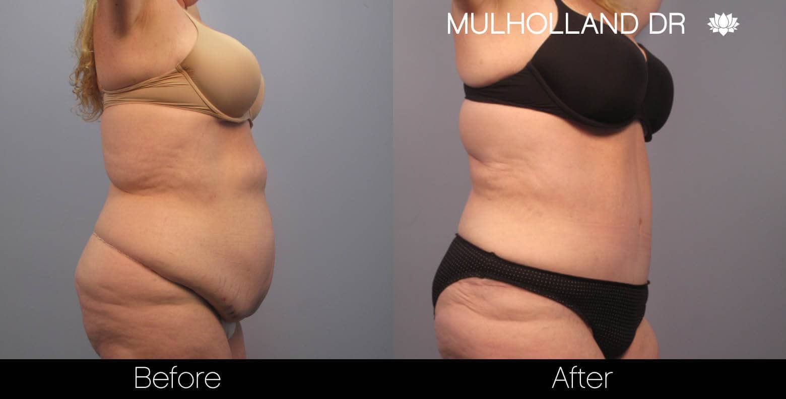 Tummy Tuck -Before and After Gallery - Patient Photo 3