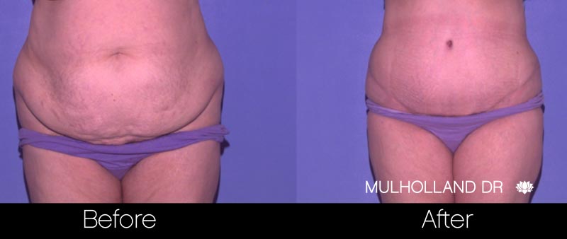 Tummy Tuck -Before and After Gallery - Patient Photo 30