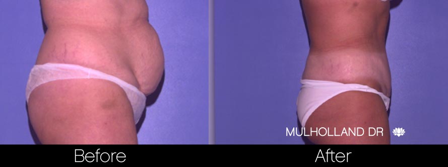 Tummy Tuck -Before and After Gallery - Patient Photo 31